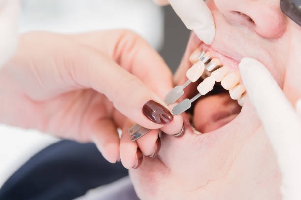 PHỤC HÌNH IMPLANT