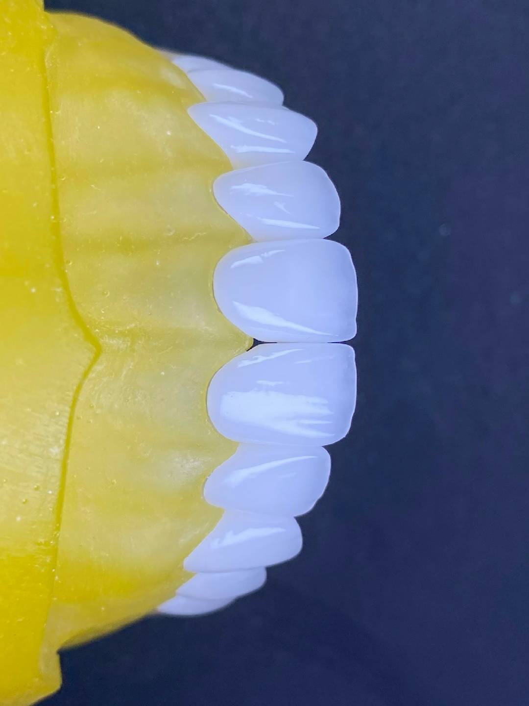 PHỤC HÌNH SỨ CERCON